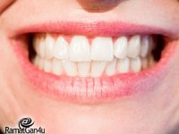 שיניים תותבות – לא רק אצל מבוגרים