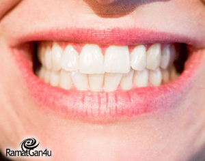 הלבנת שיניים באמצעות חיפוי חרסינה